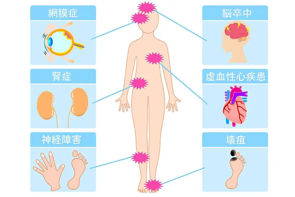 糖尿病が引き起こす合併症とは