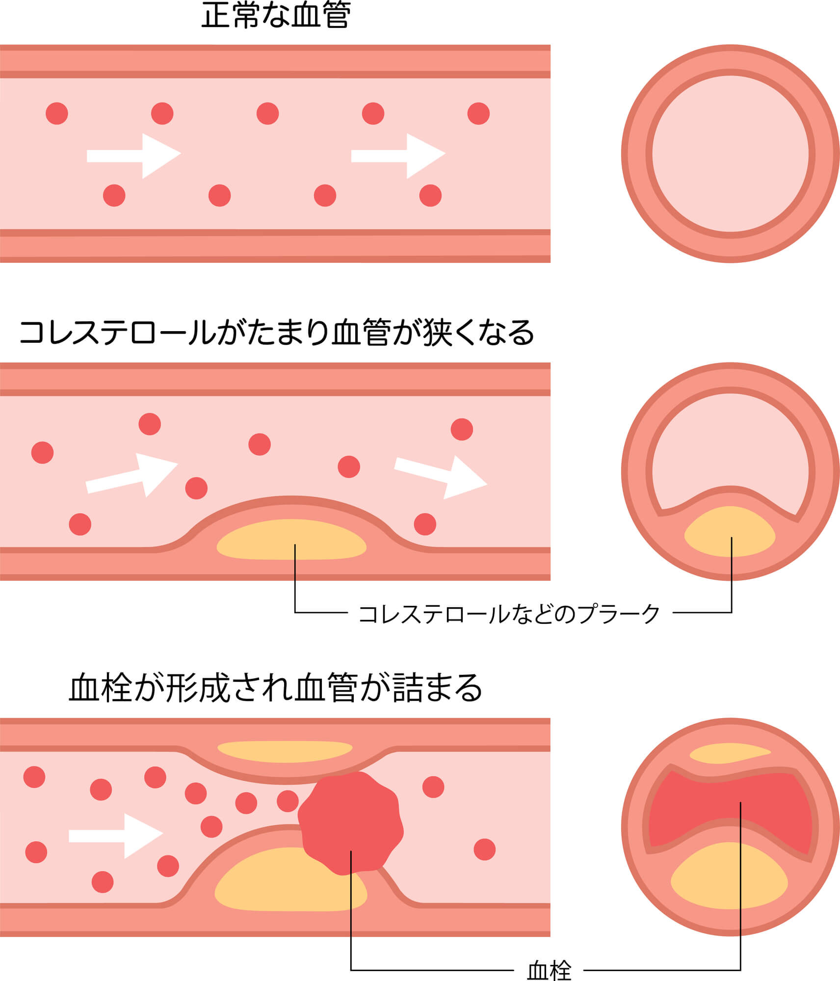 心筋梗塞の原因は？