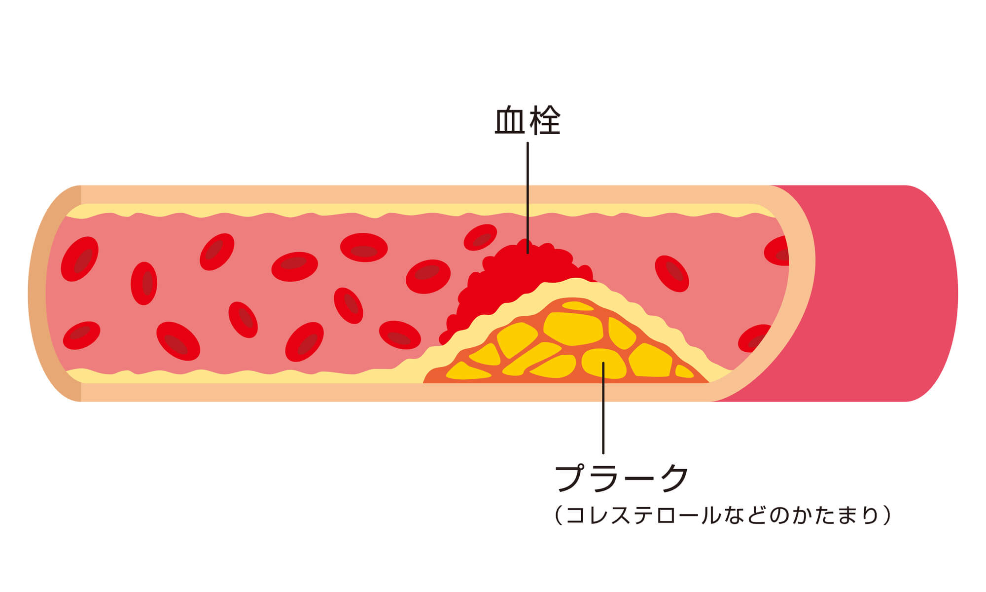 コレステロール値が高いとどうなるの？